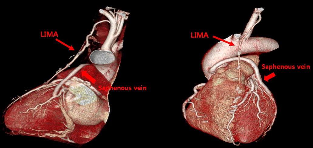 İma Grefti Nedir?