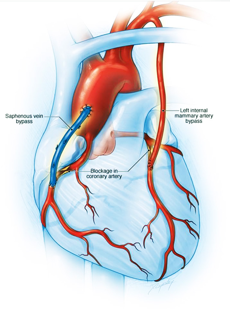 什么是 Svg Cabg？