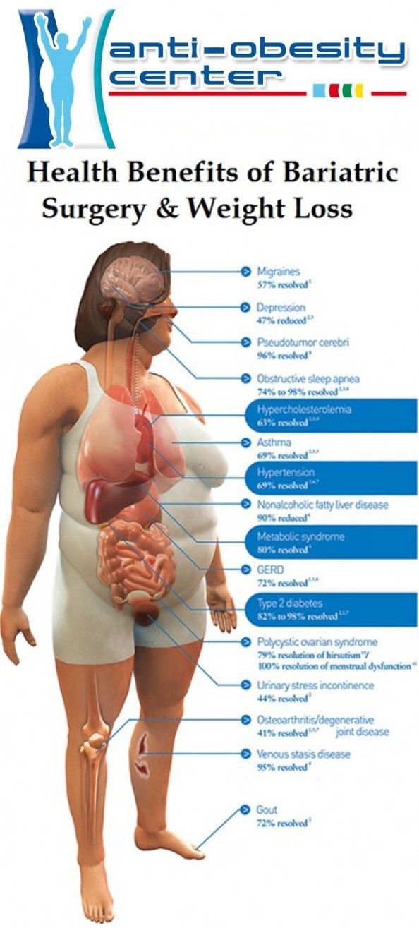 O que é a cirurgia Vsg?