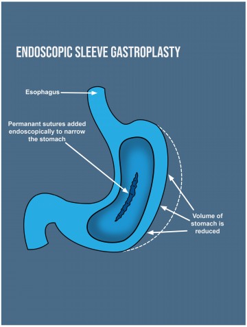 La gastroplastica con manicotto endoscopico è sicura?